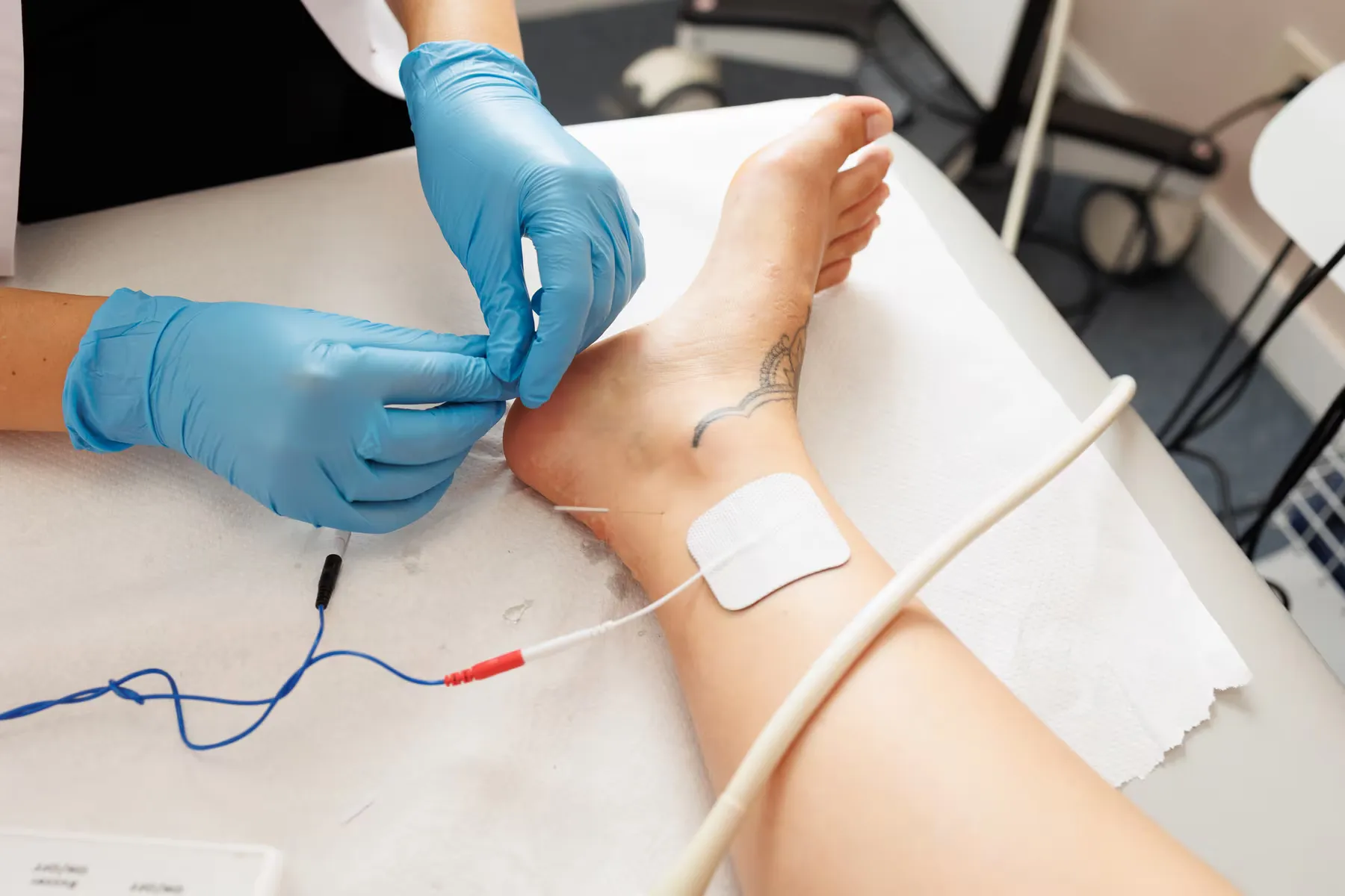 Neuromodulación percutánea: aguja conectada al equipo y electrodo de superficie en la pierna