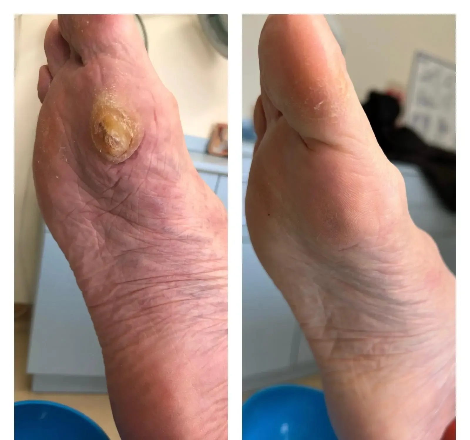 Queratosis plantar intratable antes y después del tratamiento en Centro Podológico Henao Bilbao