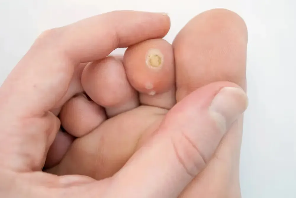 Verrugas plantares tratamiento en Bilbao