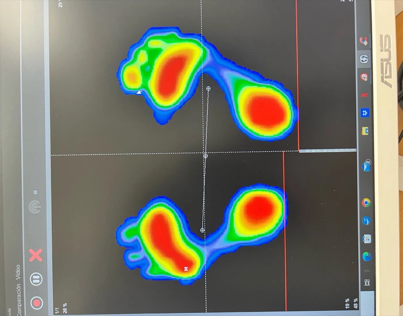 Estudio baropodométrico bilateral mostrando mapa de presiones plantares con zonas de sobrecarga en paciente con fasciopatía plantar crónica
