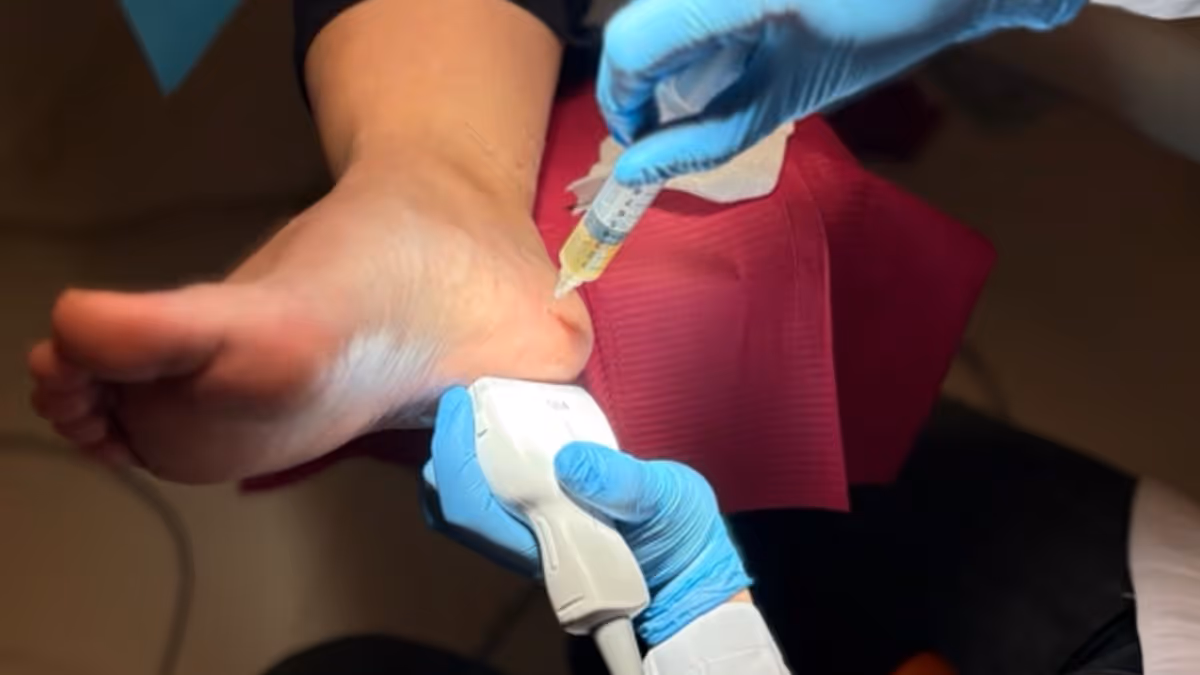 Infiltración ecoguiada de plasma rico en plaquetas (PRP) en el talón de una paciente con fasciopatía plantar crónica en Centro Podológico Henao Bilbao