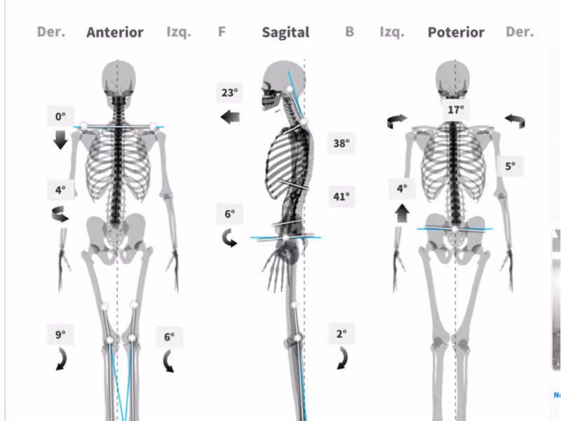 Análisis postural de paciente pediátrico con hiperlaxitud articular realizado en Centro Podológico Henao, Bilbao
