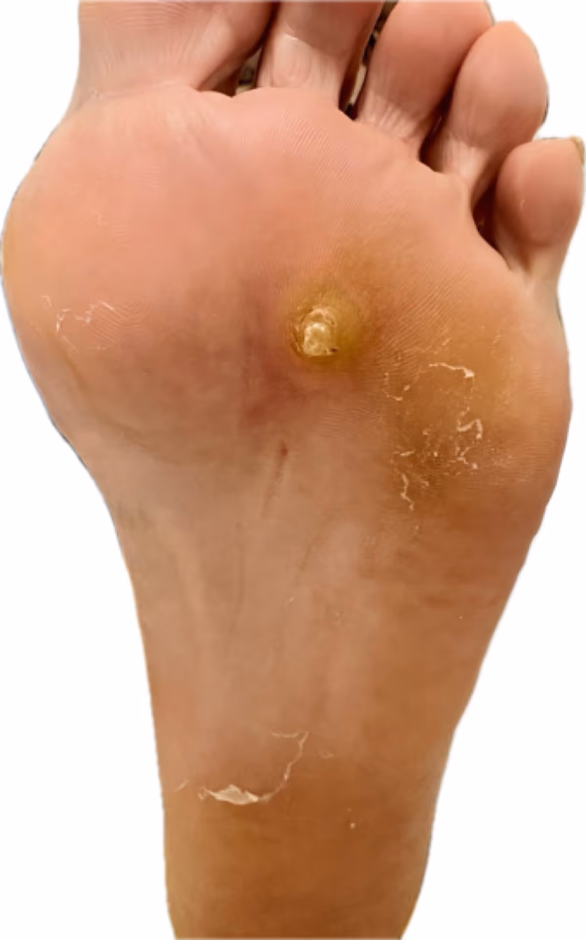 Queratosis plantar intratable con núcleo profundo visible tras desbridamiento