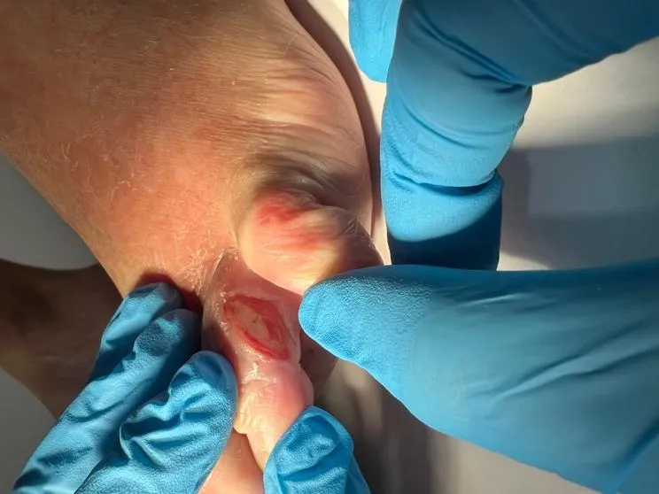 Perfil de paciente geriátrico de 84 años con diabetes tipo 2 y úlcera interdigital