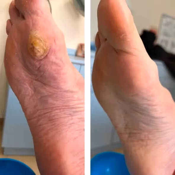 Primer dedo del pie antes y después de cirugía láser para uña encarnada recurrente