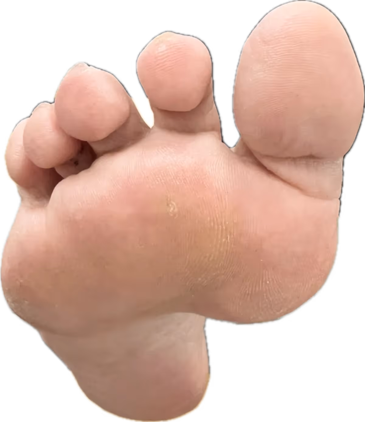 Cuerpo extraño en el pie: zona de lesión en planta antes del diagnóstico en Centro Podológico Henao Bilbao