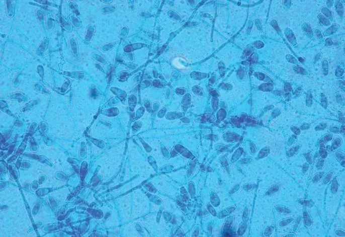 Dermatomicosis interdigital con piel macerada y descamación entre los dedos del pie