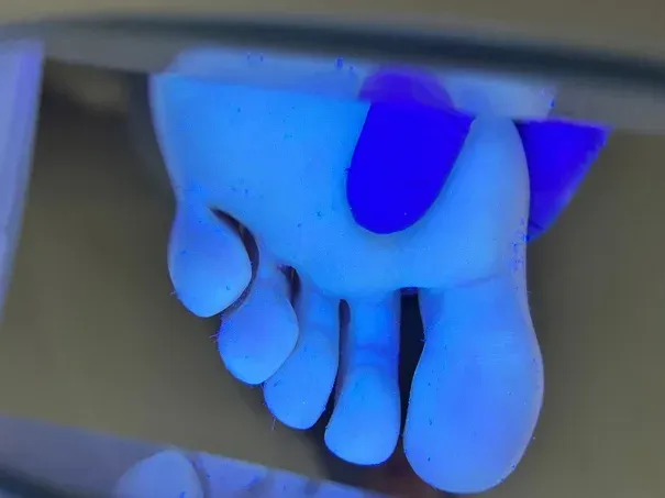 Tratamiento de dermatomicosis en consulta de podología en Bilbao