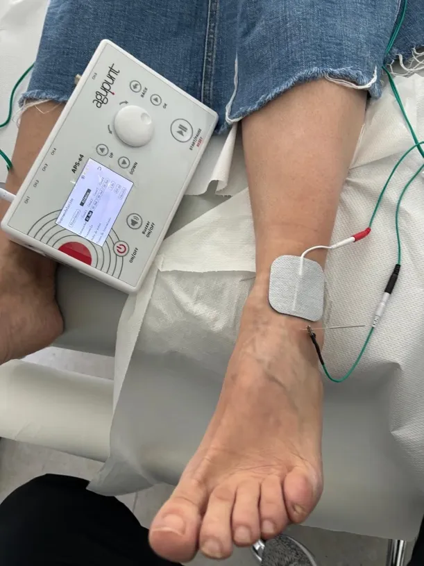 Tratamiento de electrólisis percutánea sobre la inserción del tendón tibial anterior bajo control ecográfico en consulta de podología en Bilbao