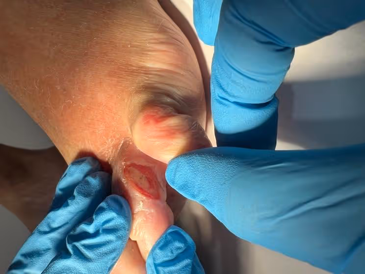 Exploración podológica del espacio interdigital del pie en consulta