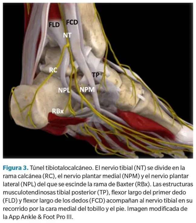 Paciente refiriendo dolor de talón con sensación de quemazón irradiada, patrón clínico orientativo de origen neuropático