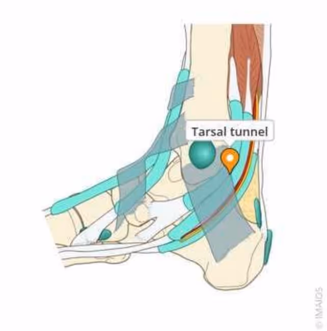 Hidrodisección ecoguiada del nervio tibial a nivel maleolar para tratamiento del dolor neuropático del talón, en consulta de podología en Bilbao