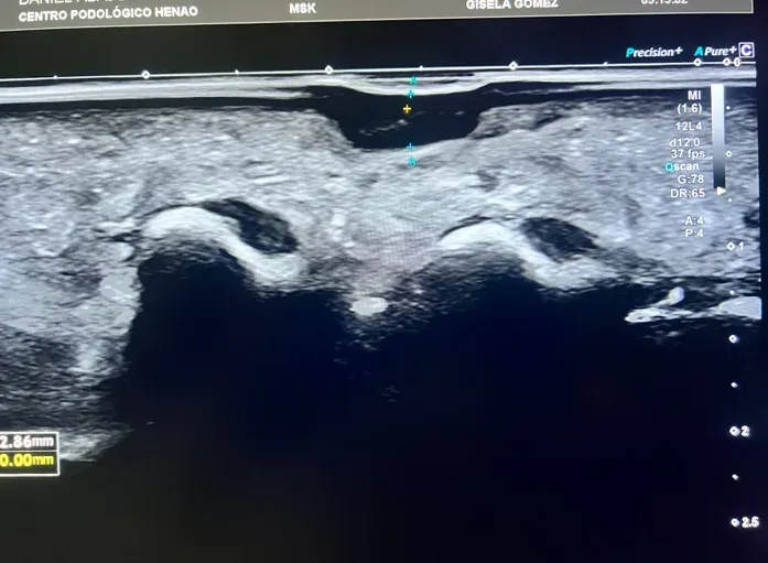 Imagen ecográfica de la lesión plantar mostrando la estructura interna y profundidad real de la lesión