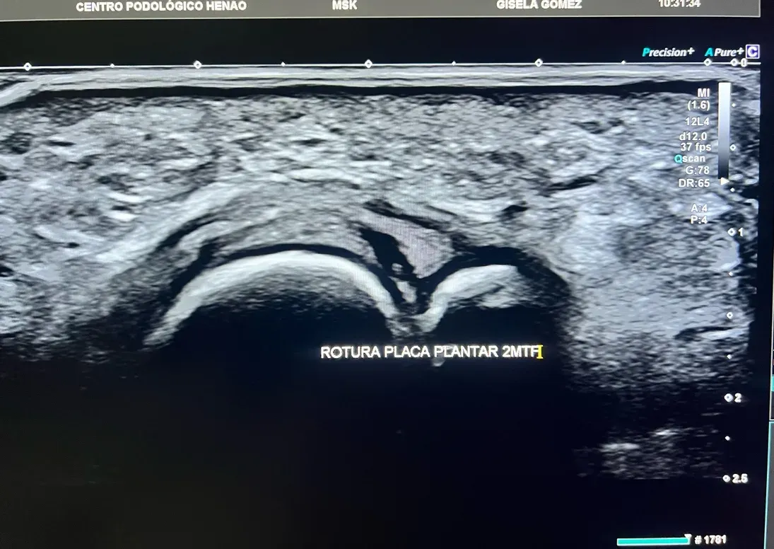 Ecografía de la zona metatarsal evaluando el estado de los tejidos y la placa plantar