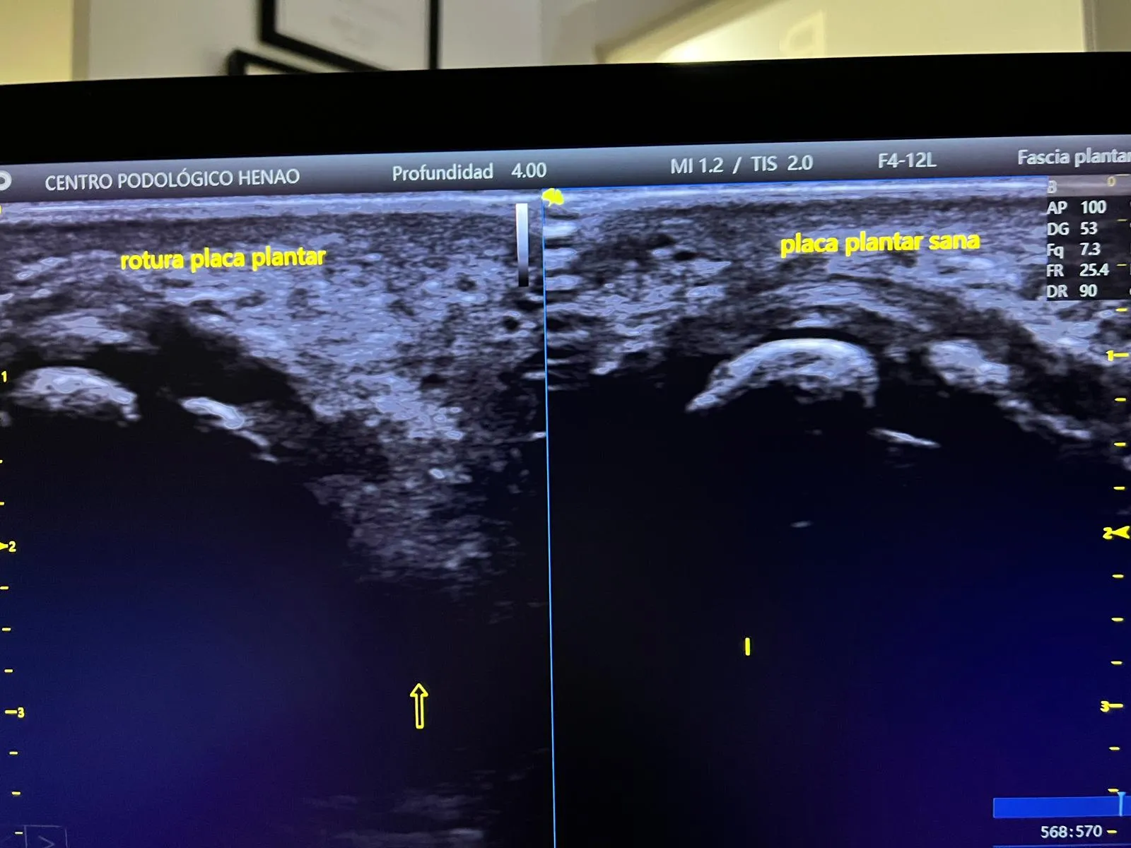 Ecografía comparativa realizada en Centro Podológico Henao: a la izquierda se observa la rotura de la placa plantar del tercer metatarsiano y a la derecha la placa plantar sana del pie contralateral
