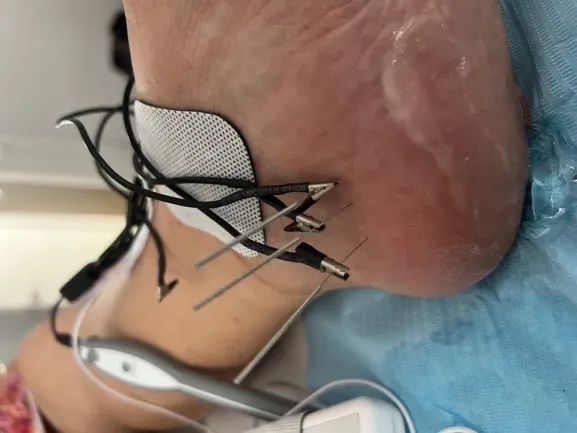 Tratamiento de electrólisis percutánea ecoguiada en fasciopatía plantar en Centro Podológico Henao