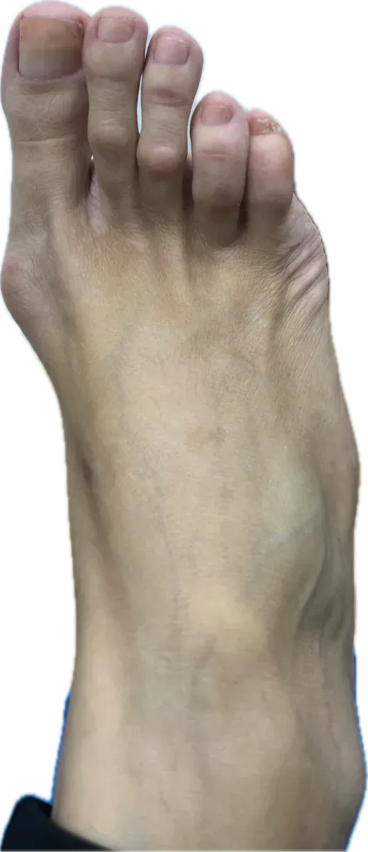 Deformidad dorsal del hallux valgus con desviación de dedos menores