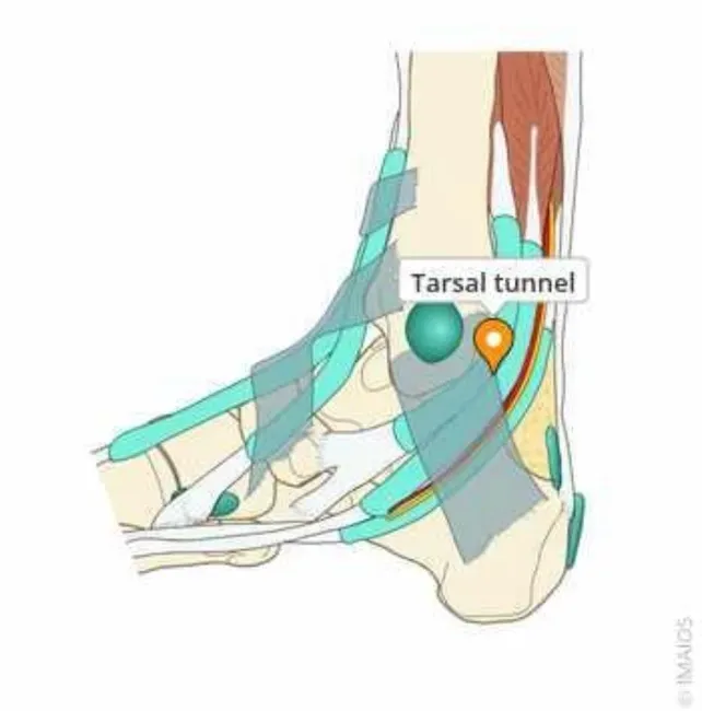 Procedimiento de hidrodisección ecoguiada del nervio tibial a nivel maleolar en consulta de podología en Bilbao