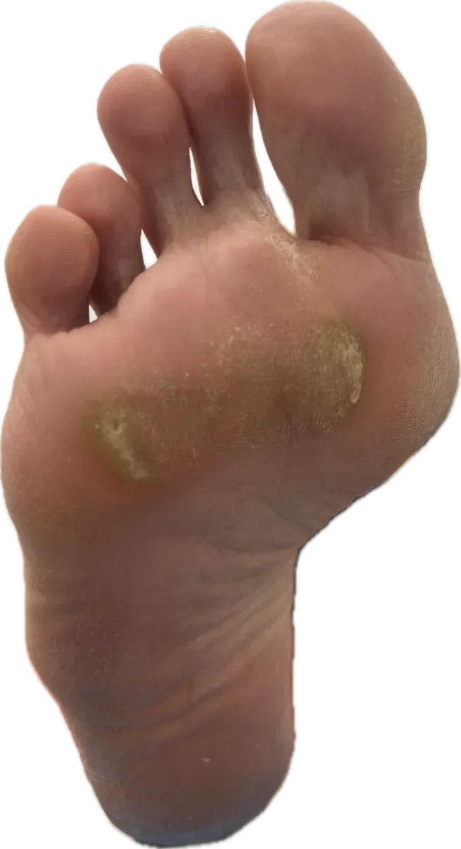 Hiperqueratosis plantar severa en antepié derecho antes del tratamiento
