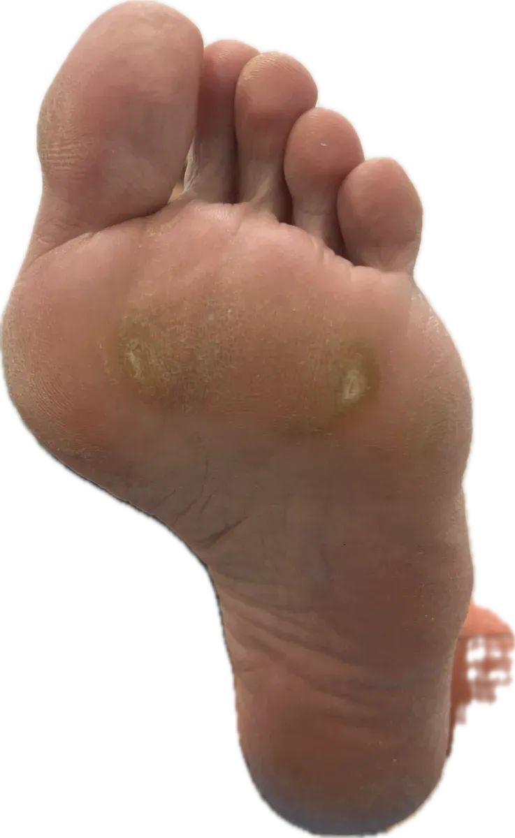 Hiperqueratosis plantar en antepié izquierdo antes del tratamiento