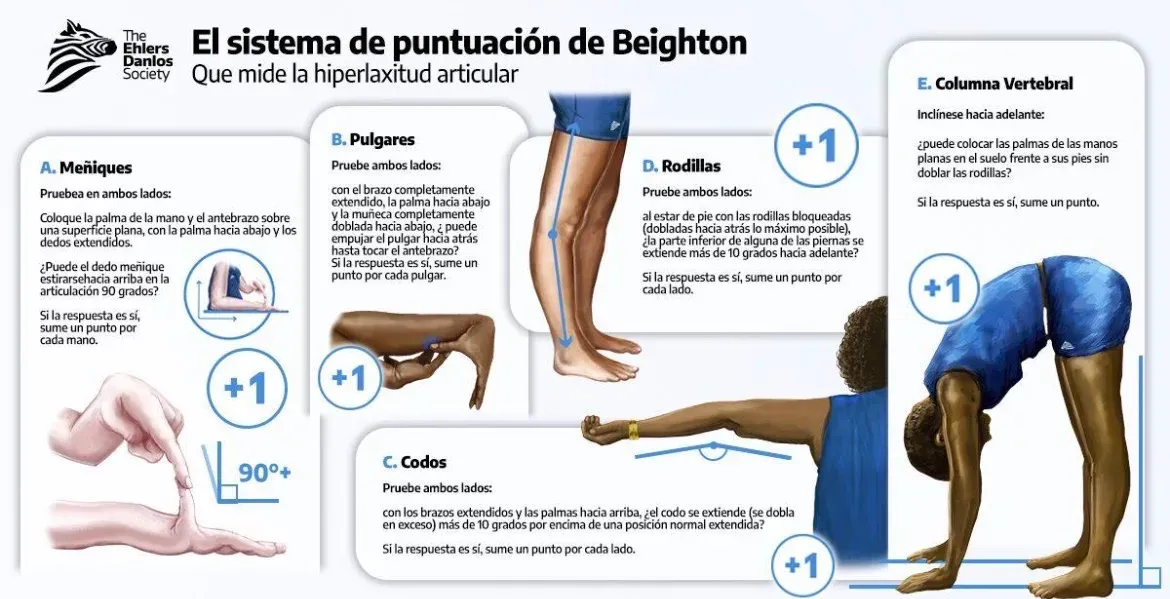 Infografía del sistema de puntuación de Beighton: meñiques, pulgares, codos, rodillas y columna vertebral
