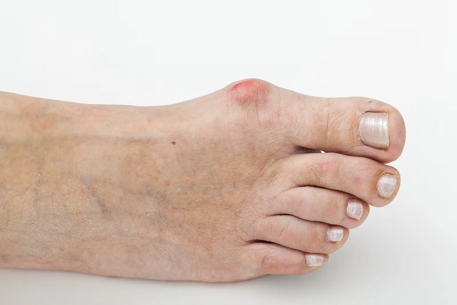Juanetes hallux valgus tratamiento podologico