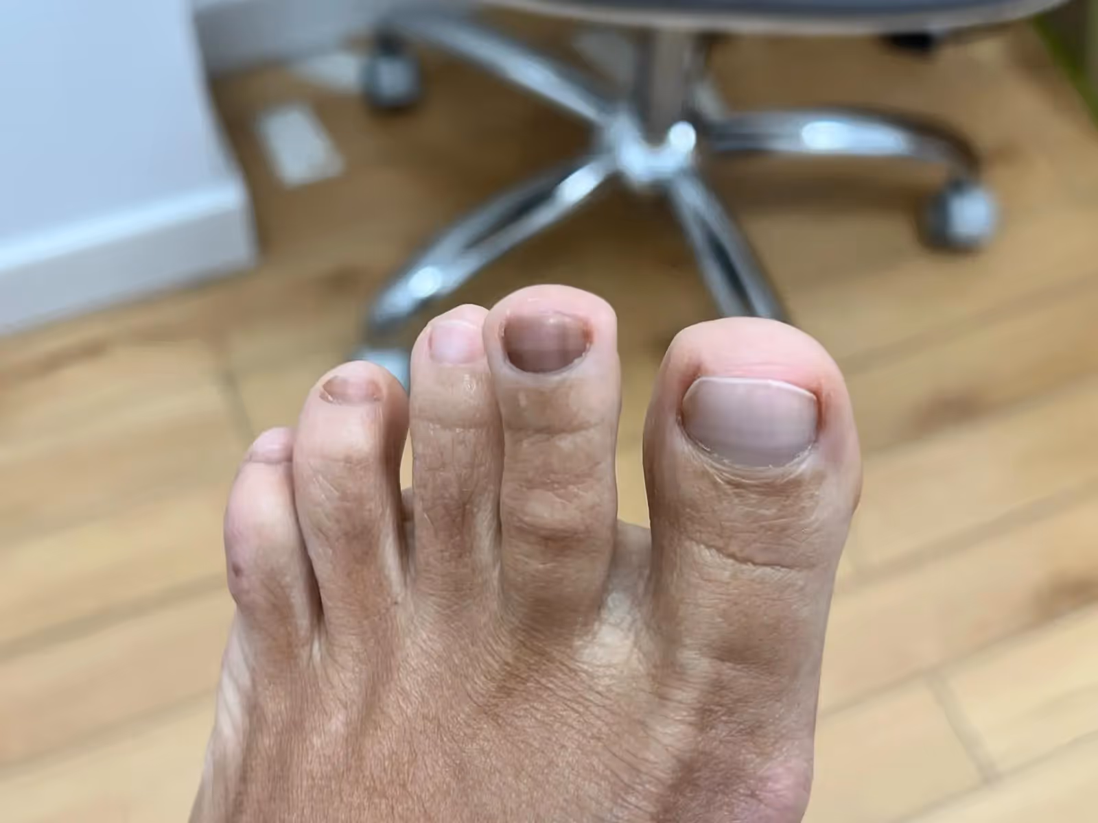 Diagnóstico diferencial de uña negra con dermatoscopia en consulta podológica