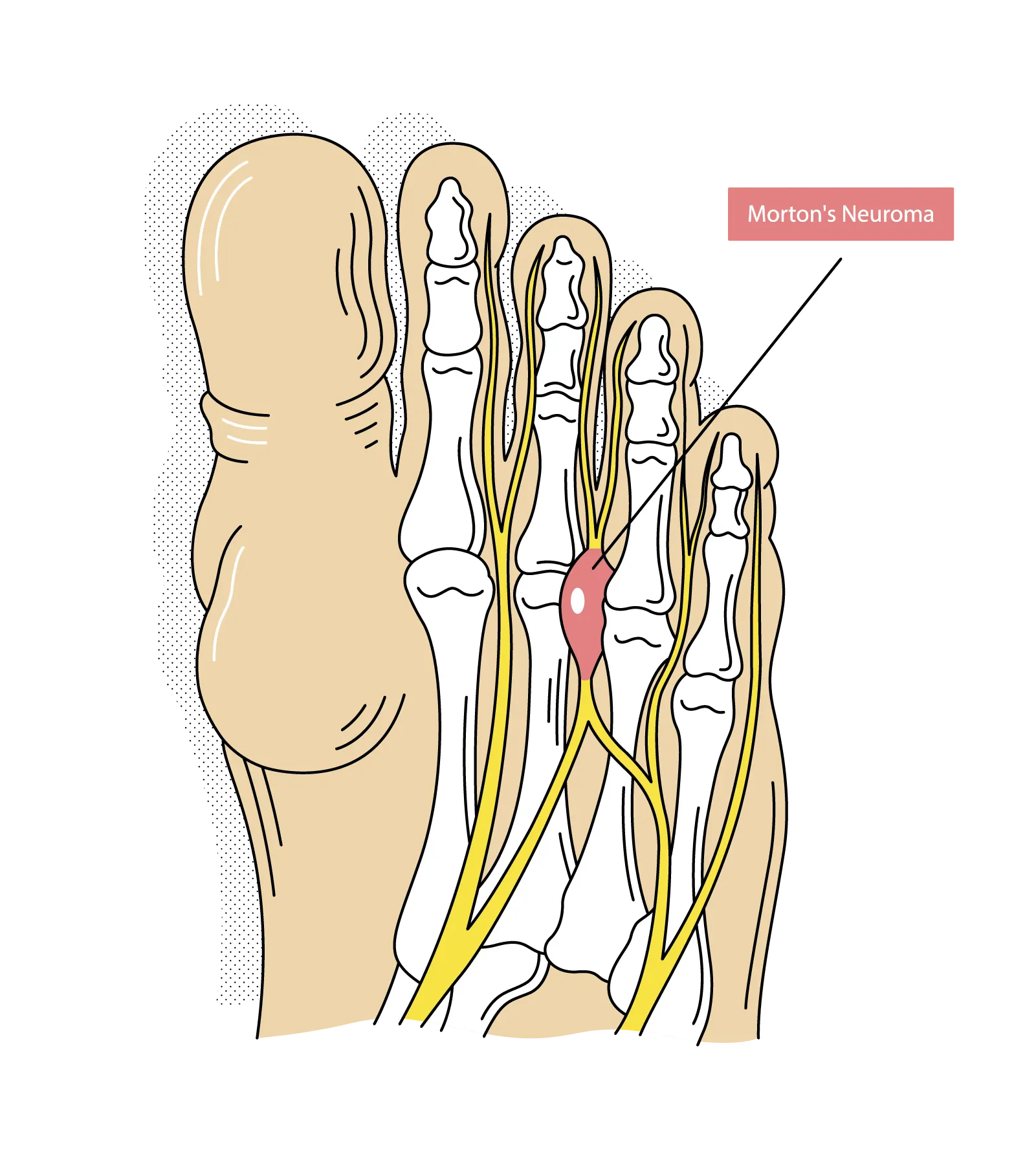 Diagnóstico de neuroma de Morton en Centro Podológico Henao Bilbao