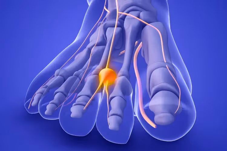 Tratamiento del neuroma de Morton con técnicas avanzadas en Bilbao