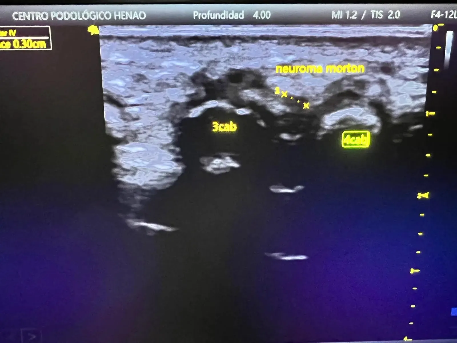 Tratamiento del neuroma de Morton en Centro Podológico Henao Bilbao