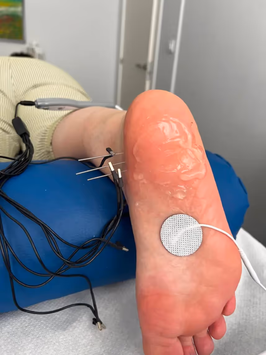 Tratamiento de neuromodulación en Centro Podológico Henao