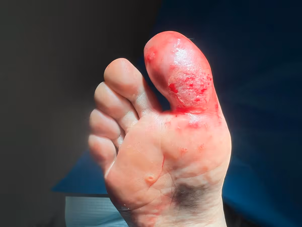 Verruga plantar en mosaico resistente en dedo gordo antes del tratamiento con técnica Falknor en Centro Podológico Henao Bilbao