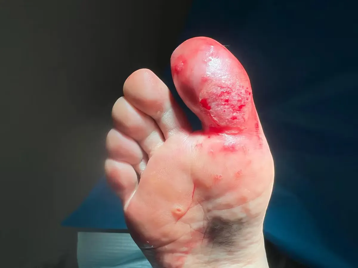 Verruga plantar en mosaico resistente en dedo gordo antes del tratamiento con técnica Falknor en Centro Podológico Henao Bilbao