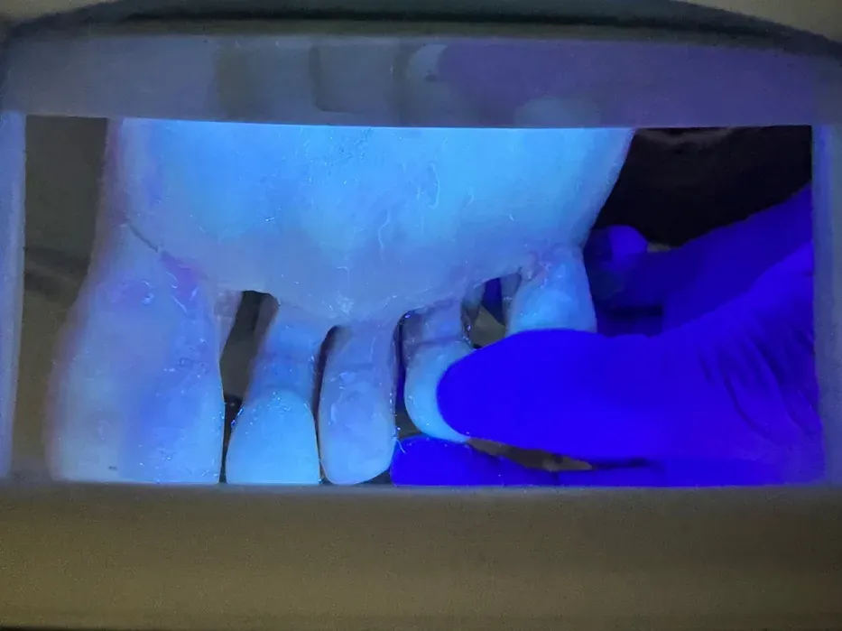 Infección interdigital por pie de atleta en zona entre los dedos del pie