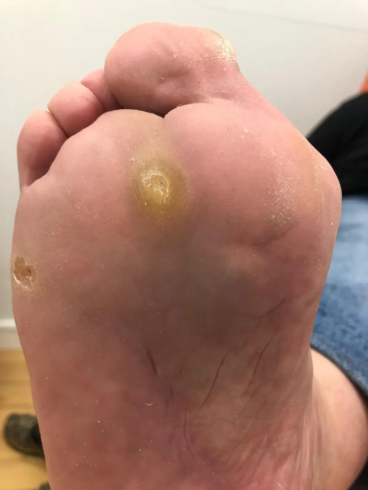 Tratamiento láser de queratosis plantar en consulta