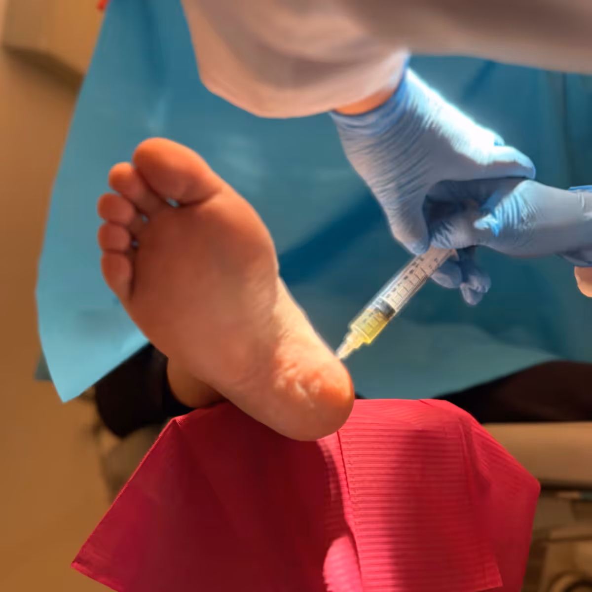 Infiltración ecoguiada de plasma rico en plaquetas en la fascia plantar en Bilbao