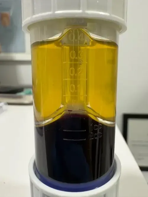Tubo de plasma rico en plaquetas (PRP) tras la centrifugación, con el plasma separado de la serie roja, en Centro Podológico Henao Bilbao