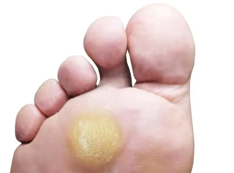 Queratosis Plantar