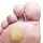 Queratosis Plantar
