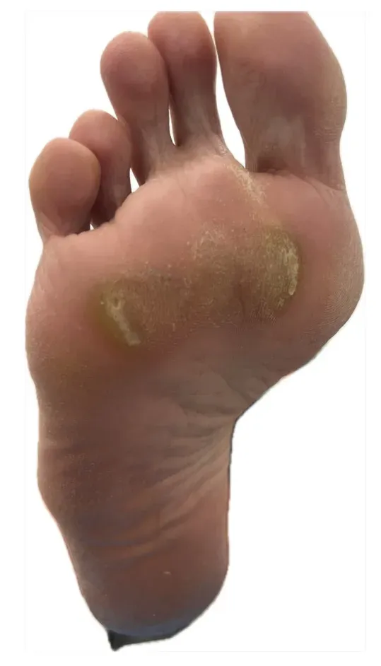 Resultado plantar del pie izquierdo tras la intervención