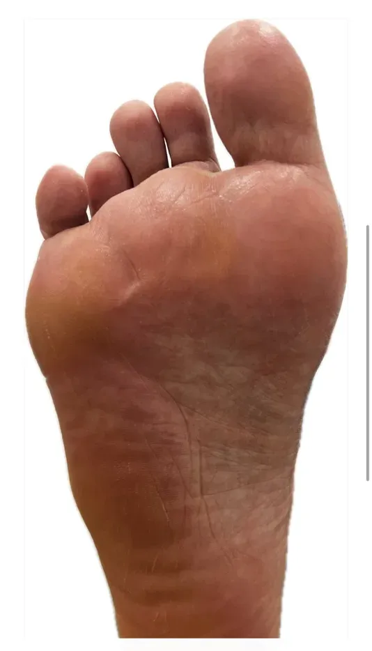 Planta del pie sin hiperqueratosis tras la cirugía MIS