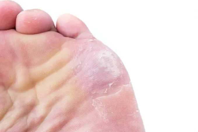 Tratamiento de hongos en los pies con terapia láser en consulta podológica