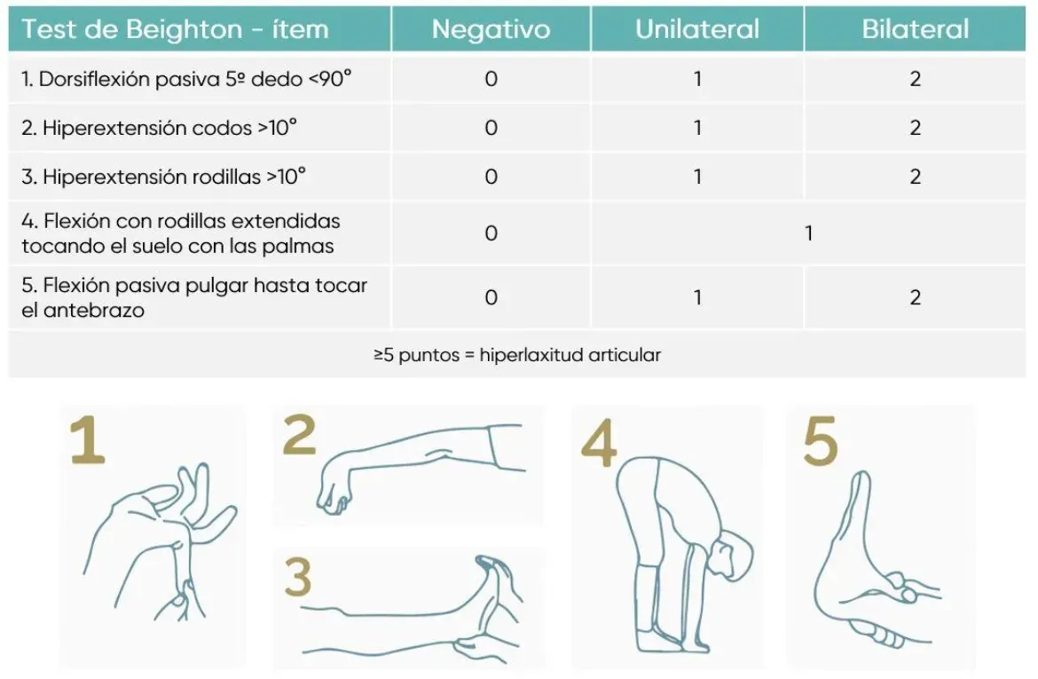 Tabla del Test de Beighton con puntuación por ítem: negativo, unilateral y bilateral