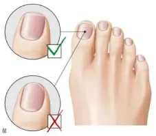 Uña encarnada en el dedo gordo del pie