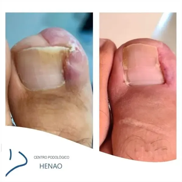 Cirugía láser de uña encarnada — preparación