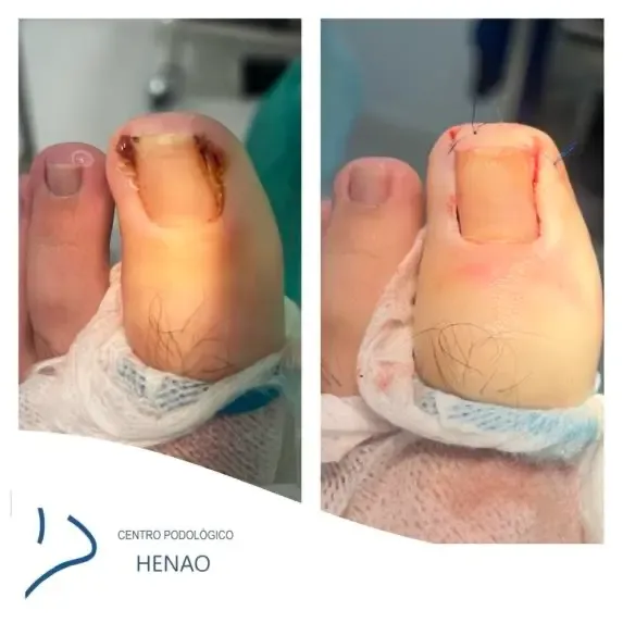 Cirugía láser de uña encarnada — procedimiento