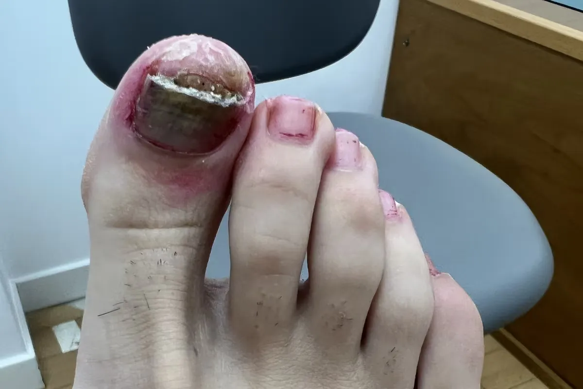 Uña del pie con hematoma subungueal mostrando pigmentación oscura bajo la lámina ungueal