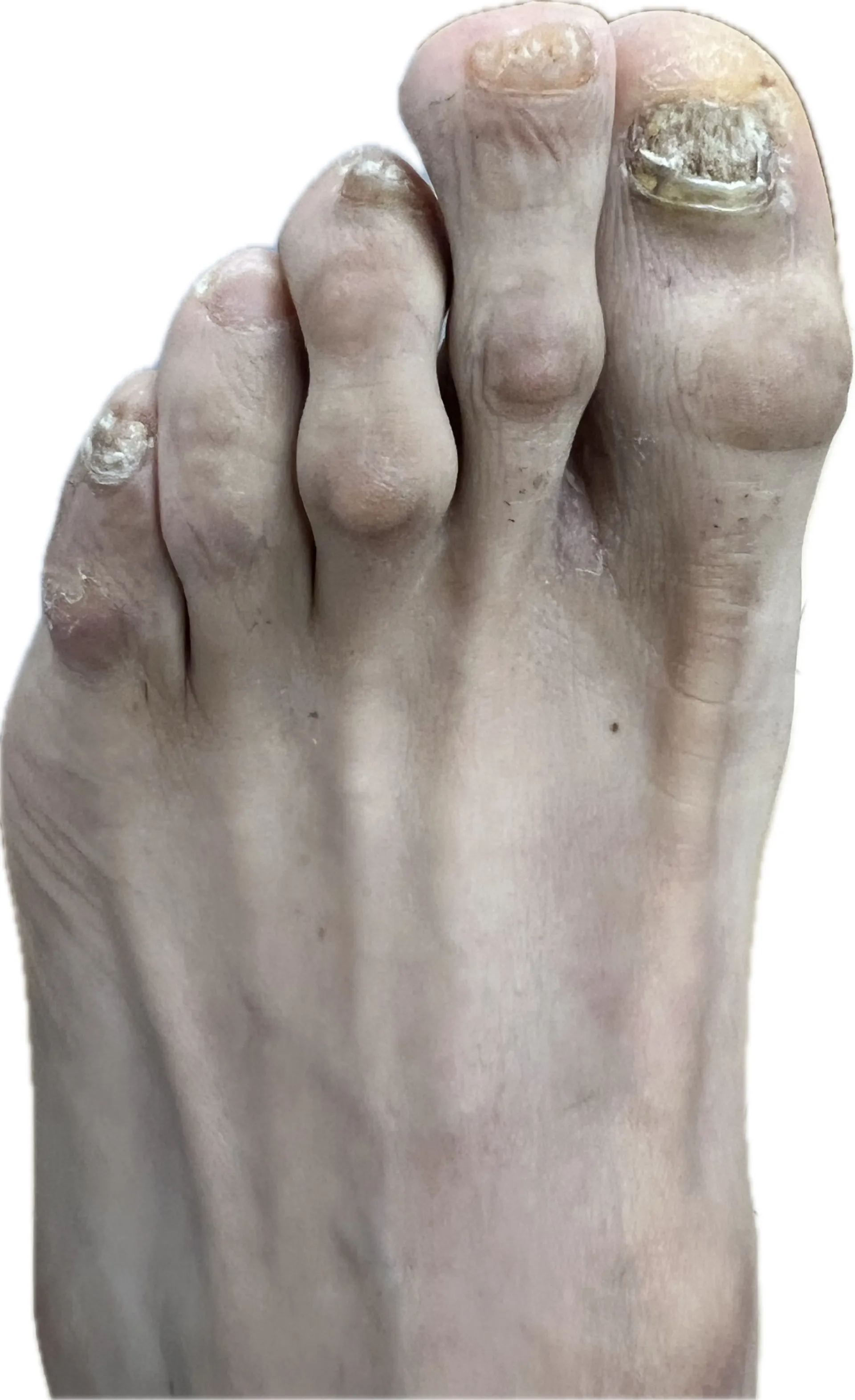 Uña con onicomicosis pigmentada mostrando coloración oscura y engrosamiento