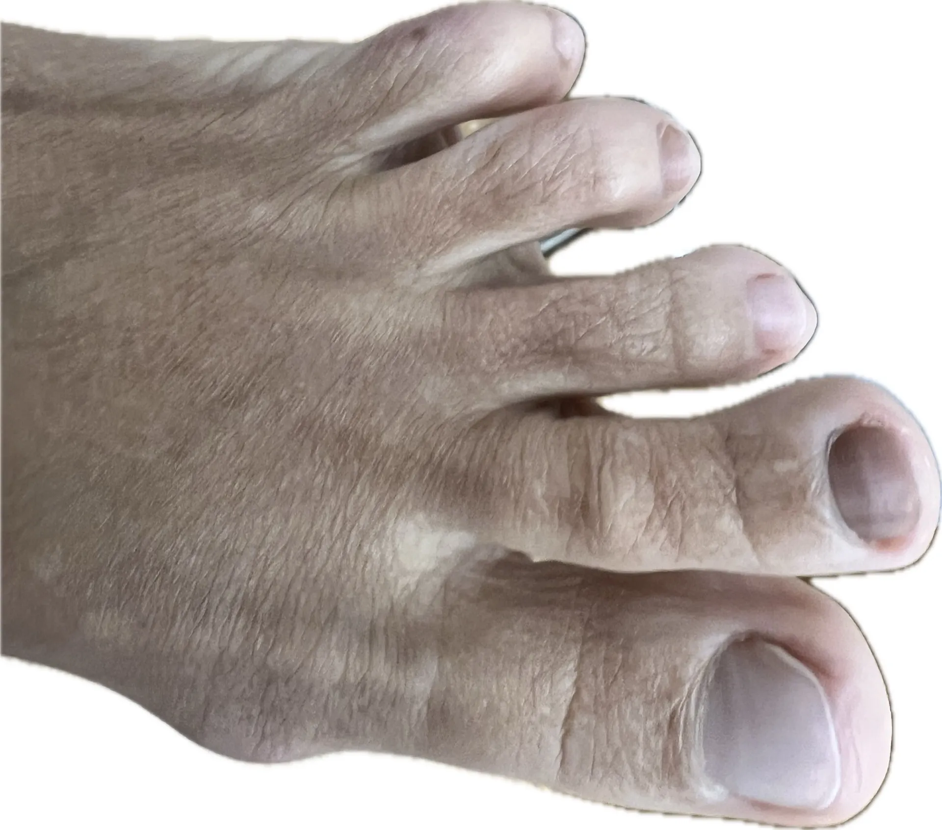 Podóloga realizando exploración clínica de uña negra en consulta