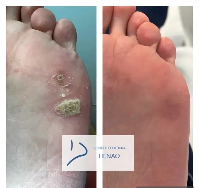 Verruga plantar antes del tratamiento quirúrgico